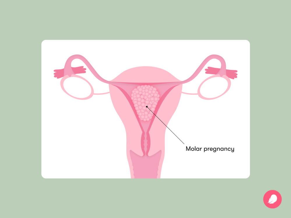 A molar pregnancy is a condition where fertilization doesn't work properly, causing abnormal tissue growth in the uterus, which, if left untreated, can lead to health problems.