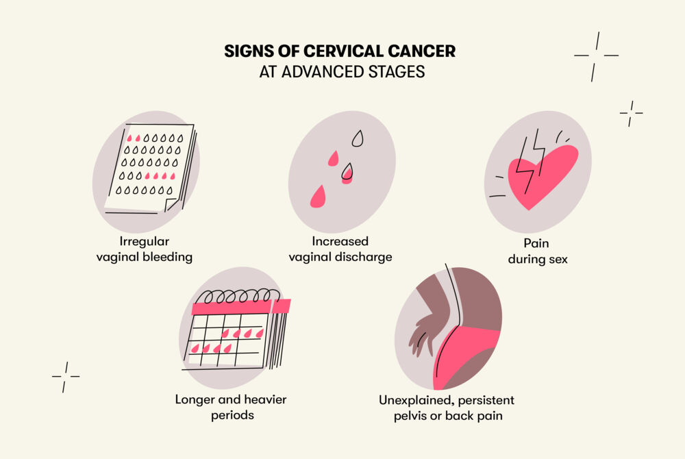 Some potential signs of advanced cervical cancer are pain during sex, irregular vaginal bleeding, longer and heavier periods, increased vaginal discharge and unexplained-frequent back pains