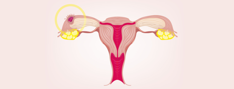 6 síntomas de un embarazo ectópico: consulta a un médico si tienes varios