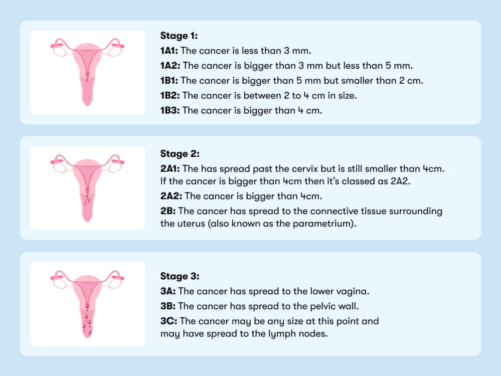 stages of cervical cancer An infographic displaying three stages and subdivisions of cervical cancer, each further divided into specific locations and measurement criteria.