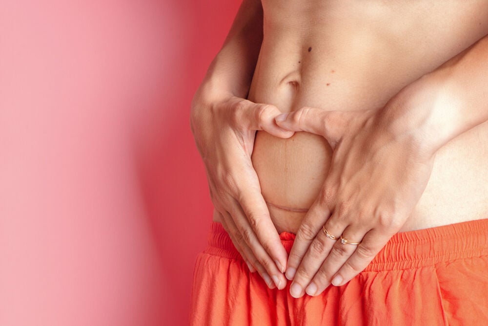 A woman recovering after a cesarean section A woman recovering after a cesarean section