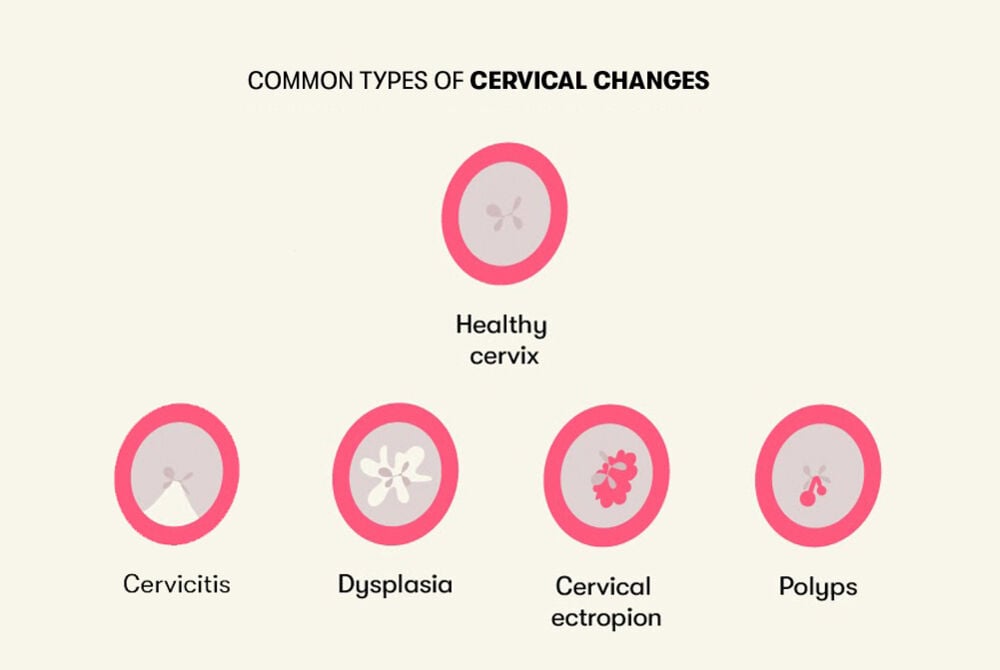 Common types of cervical changes Different abnormalities affecting the cervix, distinct from a healthy state, encompass cervicitis, dysplasia, cervical ectropion, and polyps.