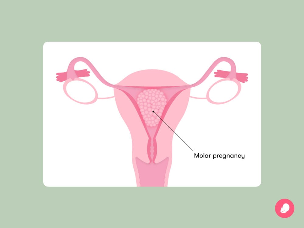 Diagram showing what a molar pregnancy looks like A molar pregnancy is a condition where fertilization doesn't work properly, causing abnormal tissue growth in the uterus, which, if left untreated, can lead to health problems.