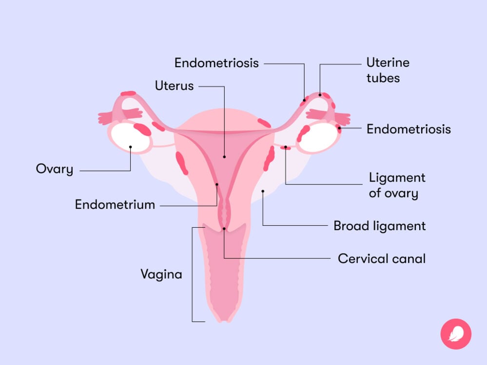 diagram of reproductive organs with endometriosis An illustration displaying the parts of the female reproductive system, emphasizing potential sites where endometriosis may occur.