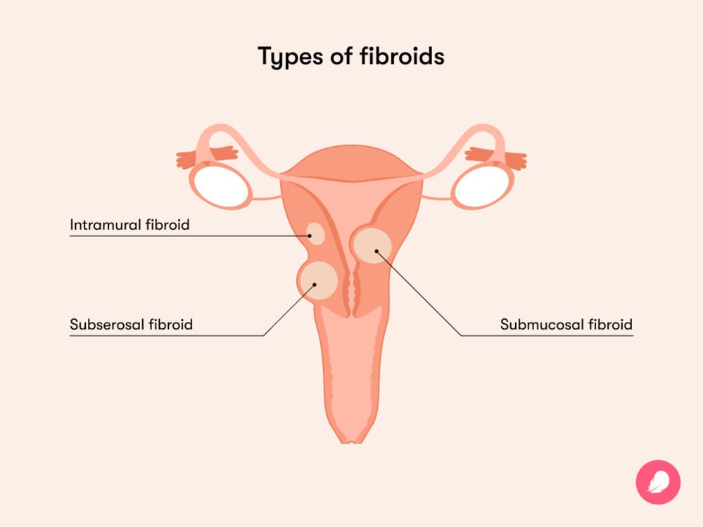 The most common types of fibroids are intramural fibroids grow in the uterus muscle wall, subserosal fibroids grow in the outer uterus and submucosal fibroids grows in the muscle layer beneath the inner lining of the uterus The most common types of fibroids are intramural fibroids grow in the uterus muscle wall, subserosal fibroids grow in the outer uterus and submucosal fibroids grows in the muscle layer beneath the inner lining of the uterus