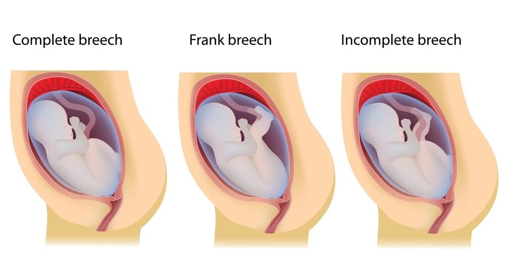 A complete breech baby is when the butt points down and legs are folded at the knees, a frank breech baby has the butt towards the birth canal with straight legs, and a footling breech baby has one or both feet pointing down as the first part of the body to come out during delivery.