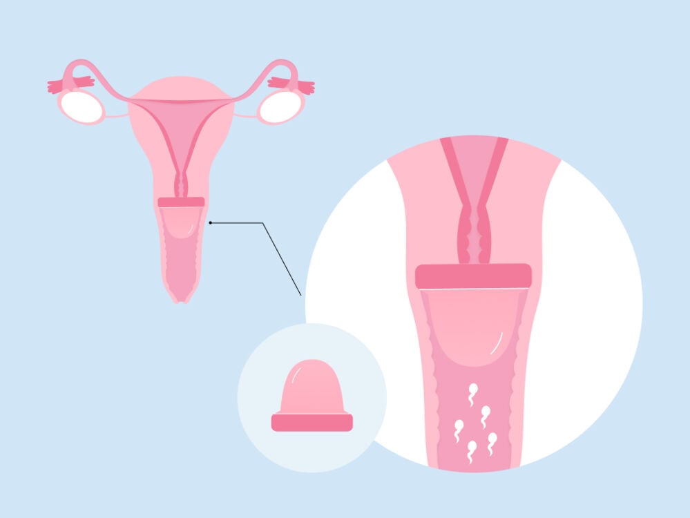 Non hormonal birth control - cervical cap Non hormonal birth control - cervical cap