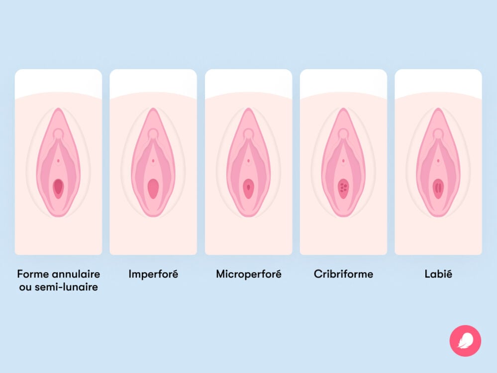 Différents types d’hymens et à quoi ils pourraient ressembler Différents types d’hymens et à quoi ils pourraient ressembler