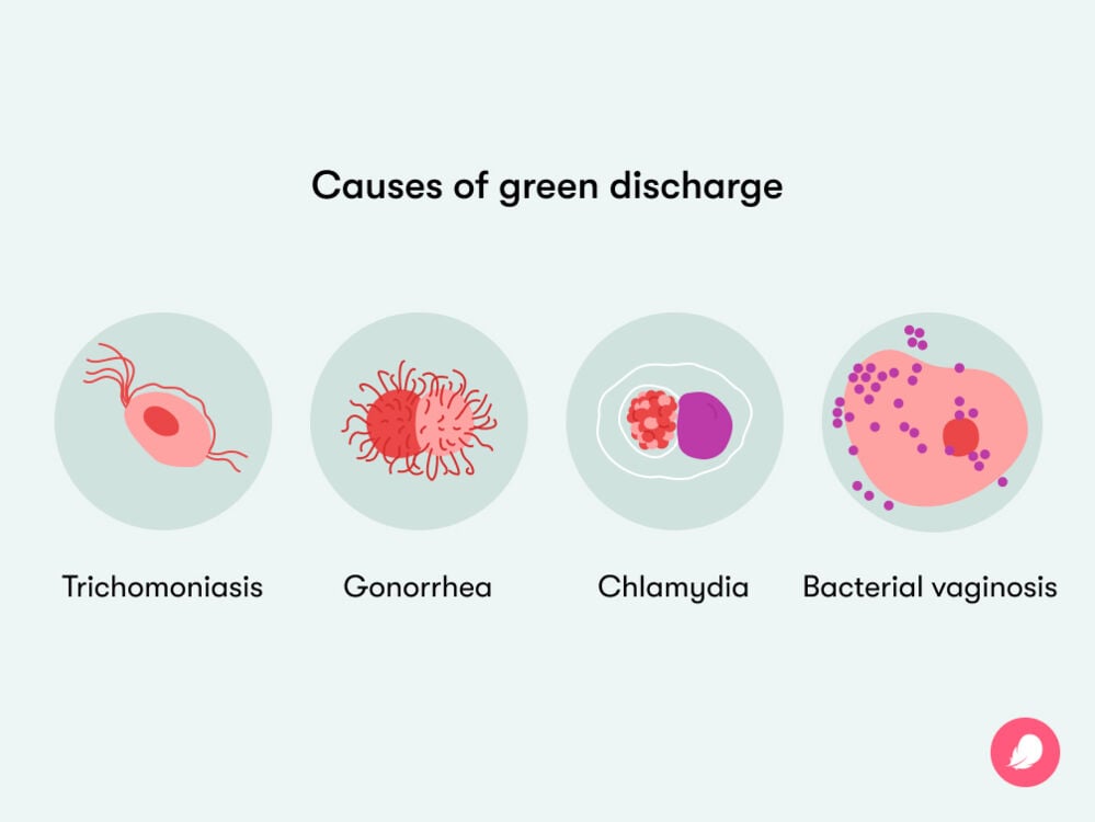 Single image Some of the causes of green vaginal discharge