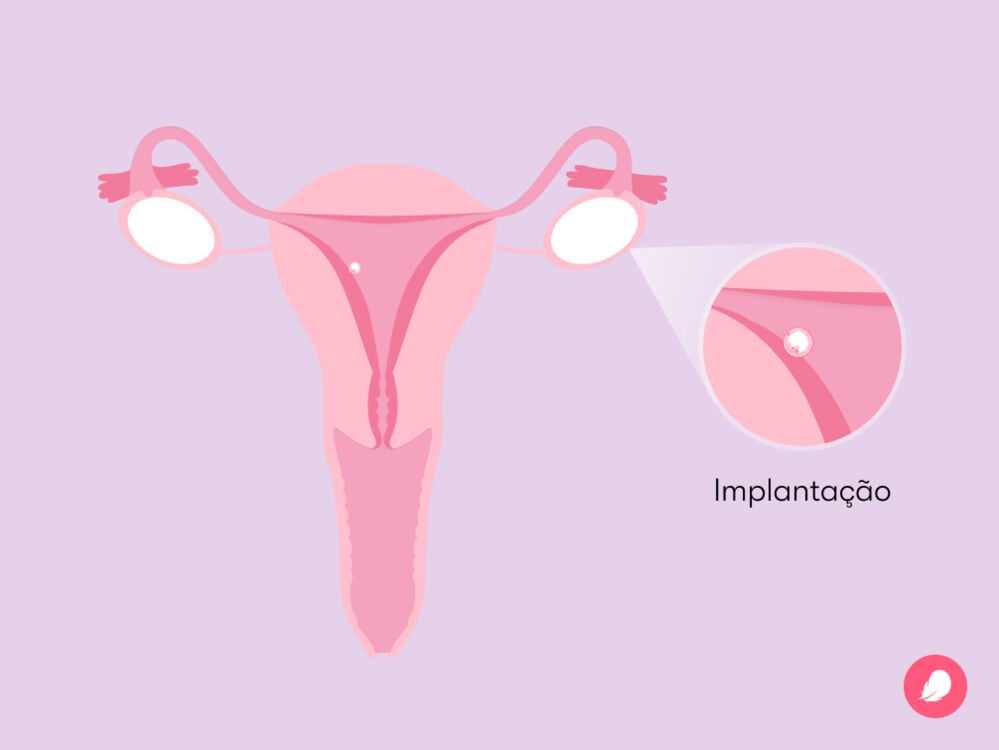 Single image Embrião implantado na parede do útero da mulher grávida