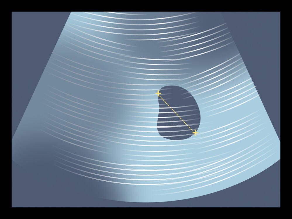 Blighted ovum Blighted ovum