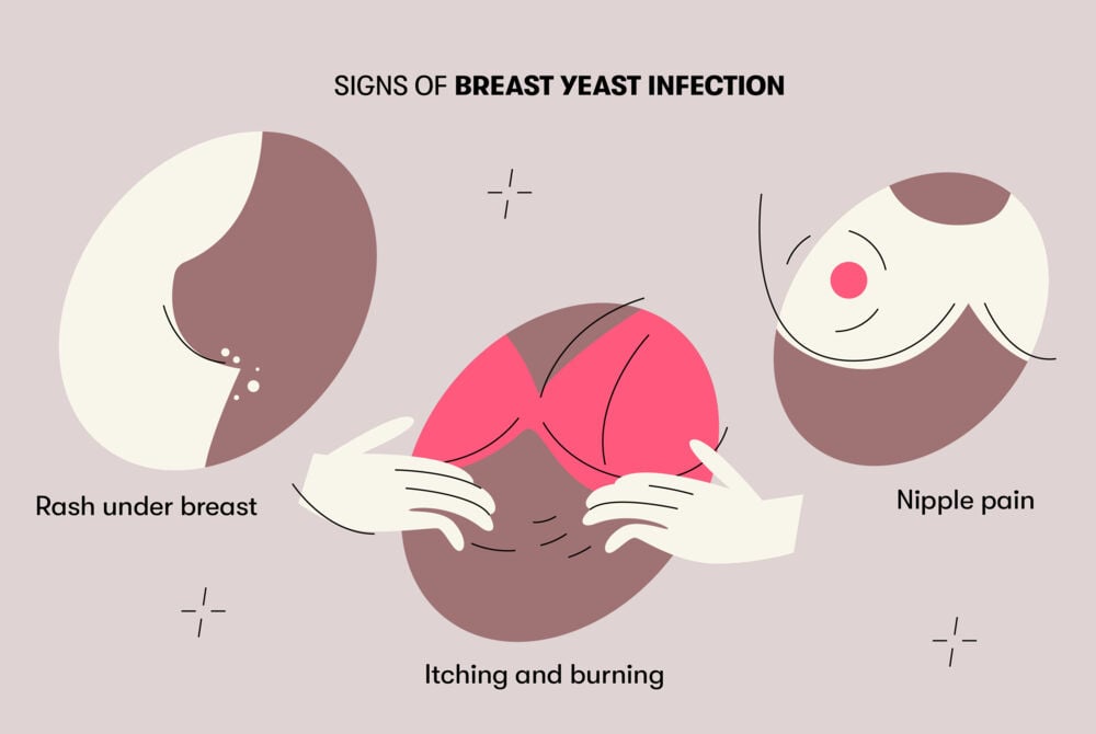 signs of breast yeast infection Nipple pain, itching, burning sensations, and a rash under the breasts are some of the most common signs of breast yeast infection