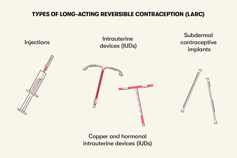 Types of long-acting reversible contraception (LARC) Long-acting reversible contraception methods include the Intrauterine device (IUD), copper and hormonal IUDs, injections, and the subdermal contraceptive implant.