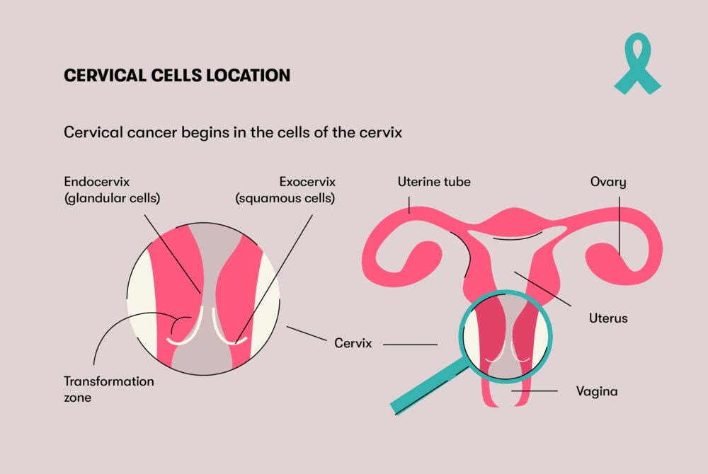 Cervical cells location The region of the cervix from which cancerous cells often originate is known as the transformation zone, situated between the exocervix and the endocervix