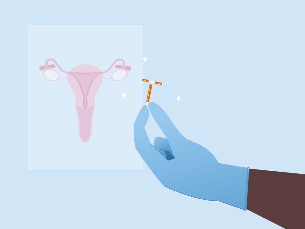 Non hormonal birth control - copper IUD Non hormonal birth control - copper IUD