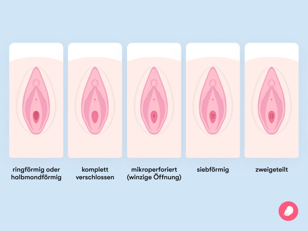 Die verschiedenen Formen des Jungfernhäutchens Die verschiedenen Formen des Jungfernhäutchens