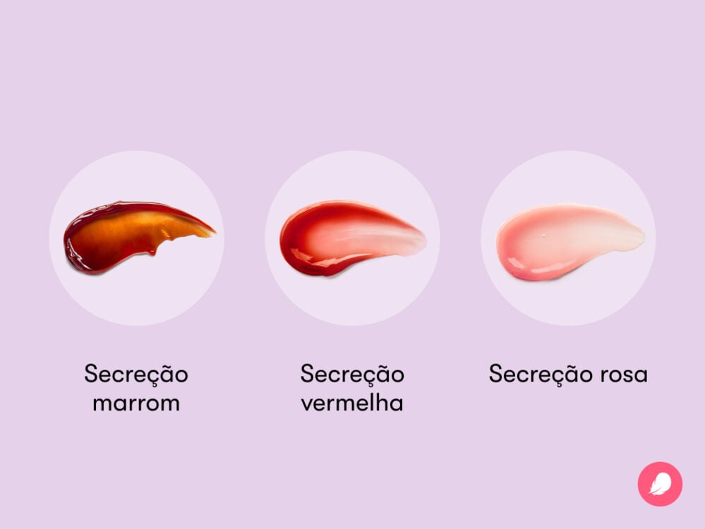 Single image Visual mostrando como o corrimento marrom, o corrimento vermelho e o corrimento rosa se parecem e diferem um do outro