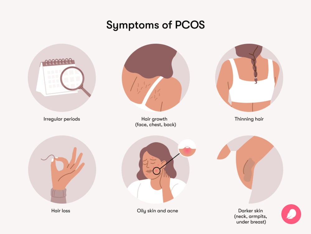 Symptoms of PCOS PCOS symptoms include hair growth, irregular periods, thinning hair, hair loss, oily skin and acne and darker skin around the neck, armpits and under the breasts