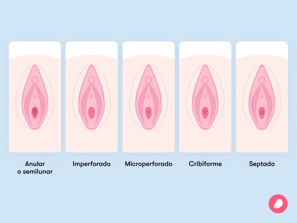 Diferentes tipos de himen y su aspecto Diferentes tipos de himen y su aspecto