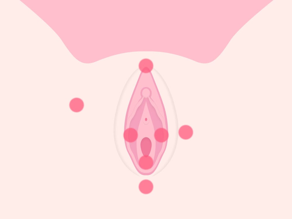 Single image Area of vulva pain