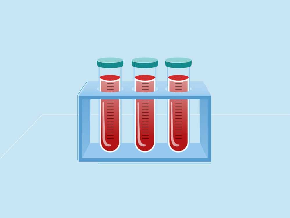 Gestational diabetes - blood test sample Gestational diabetes - blood test sample