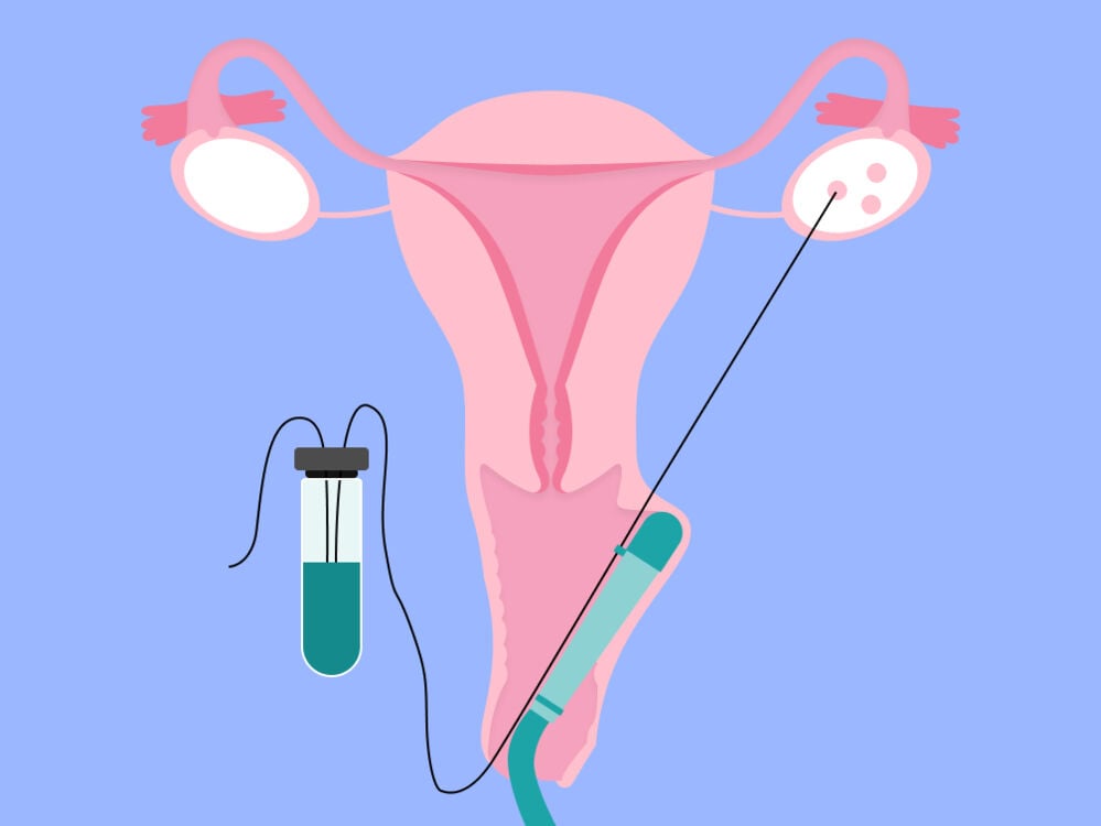 IVF egg retrieval process IVF egg retrieval process