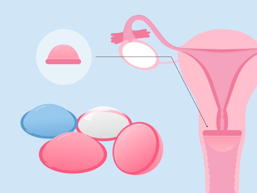 Non hormonal birth control - diaphragm Non hormonal birth control - diaphragm