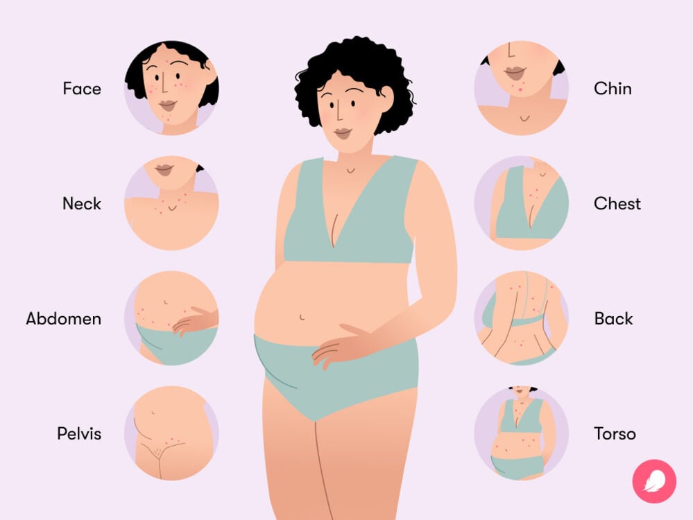 an infographic with possible pregnancy acne locations Pregnancy acne typically appears on the face, trunk and neck