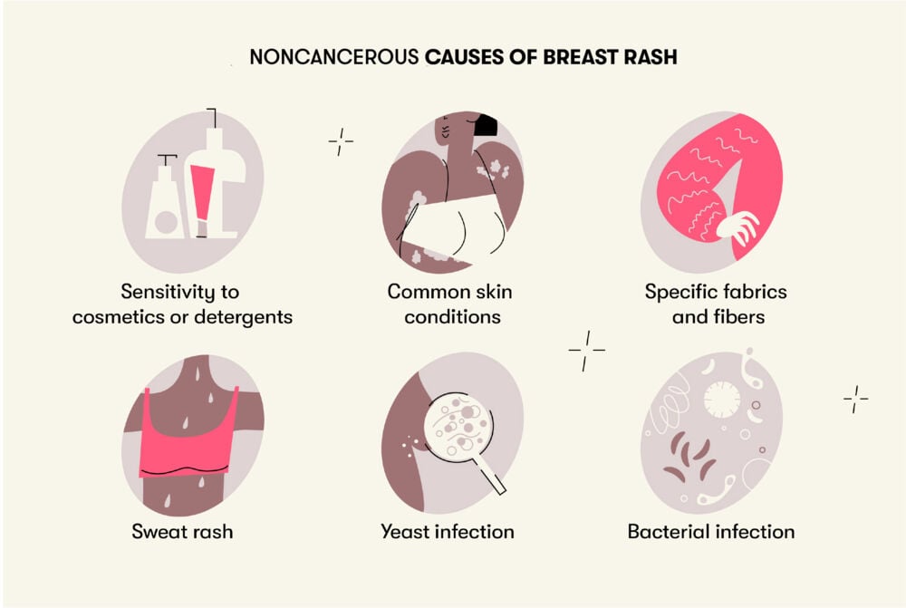 Noncancerous causes breast cancer Some noncancerous causes of breast rash include yeast infections, common skin conditions, sensitivity to cosmetics, and bacterial infections.