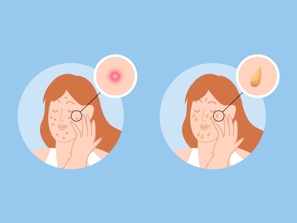 PCOS treatment PCOS treatment