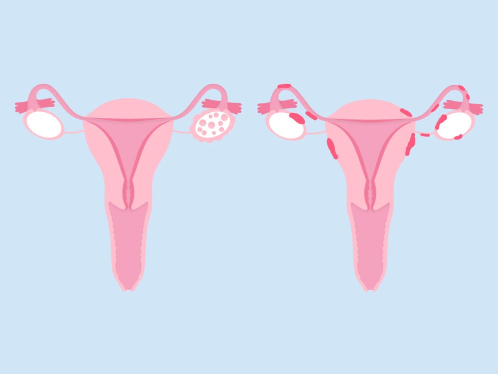 SOP vs. endometriosis SOP vs. endometriosis
