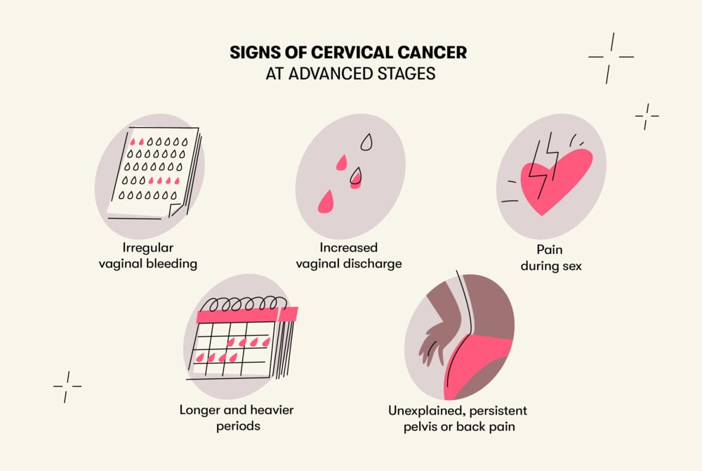 Signs of cervical cancer Some potential signs of advanced cervical cancer are pain during sex, irregular vaginal bleeding, longer and heavier periods, increased vaginal discharge and unexplained-frequent back pains