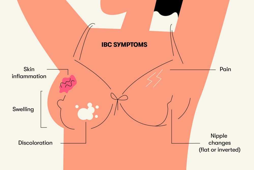 IBC symptoms Some of the common symptoms for inflammatory breast cancer include swelling, skin inflammation, nipple changes, pain and discoloration