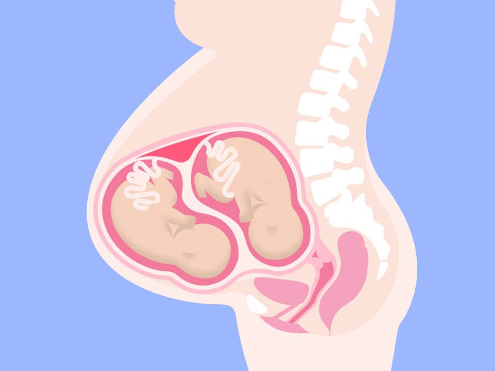 IVF twins IVF twins
