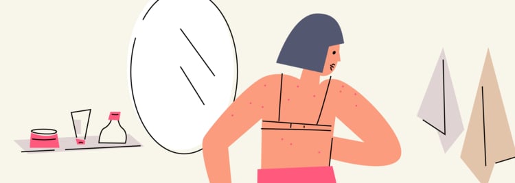 Body Acne: Everything You Need to Know Body Acne: Everything You Need to Know