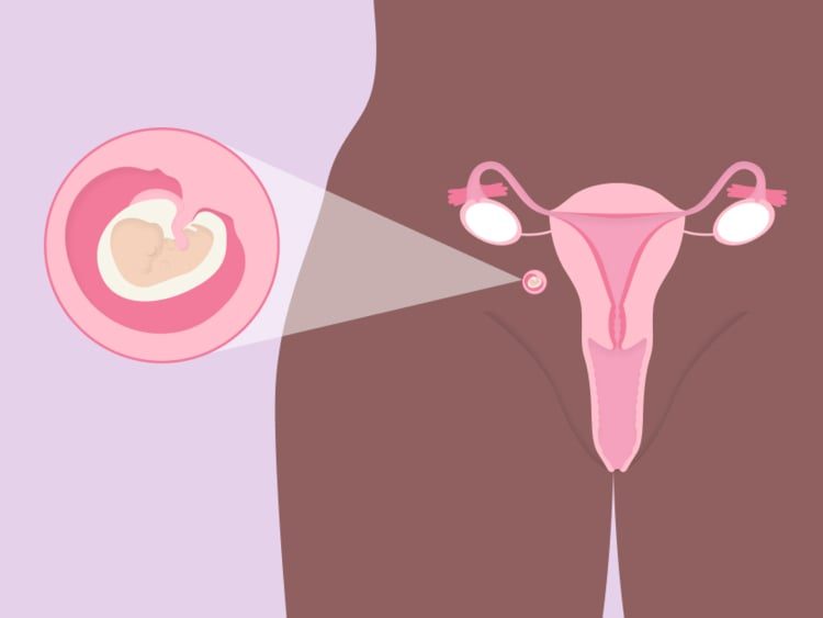 What is an abdominal pregnancy? What is an abdominal pregnancy?