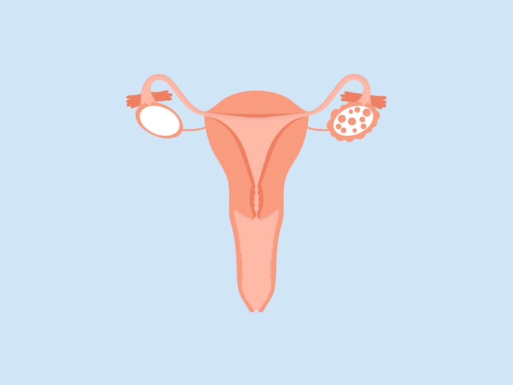 Signs of PCOS: How to know if you have polycystic ovary syndrome Signs of PCOS: How to know if you have polycystic ovary syndrome