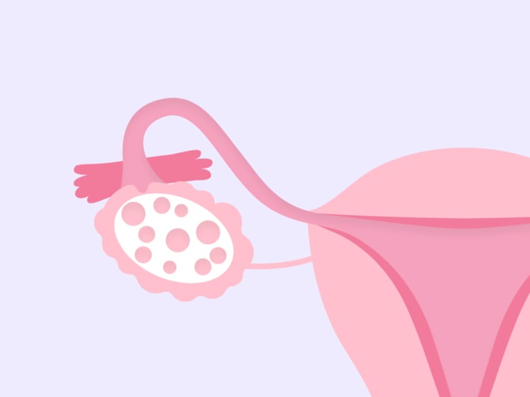 Everything you need to know about PCOS Everything you need to know about PCOS