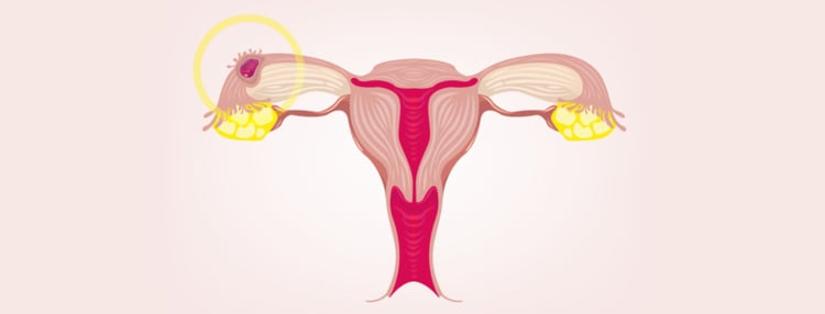 6 síntomas de un embarazo ectópico: consulta a un médico si tienes varios: consulta a un médico si tienes varios 6 síntomas de un embarazo ectópico: consulta a un médico si tienes varios: consulta a un médico si tienes varios