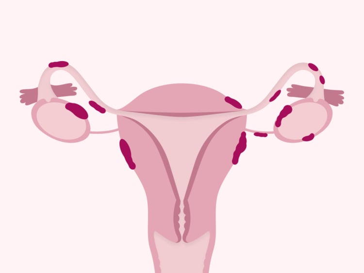 The different endometriosis treatment options explained The different endometriosis treatment options explained