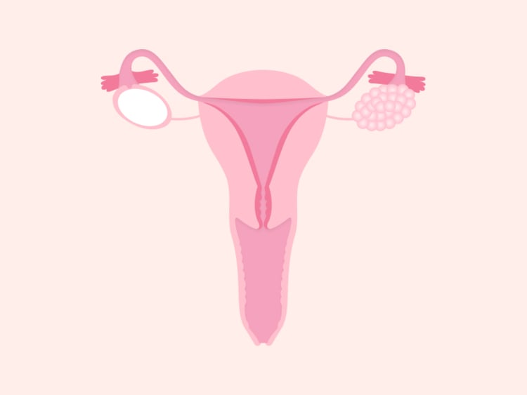 Ovarian cancer and bloating: Why cancer can be mistakenly dismissed as IBS Ovarian cancer and bloating: Why cancer can be mistakenly dismissed as IBS