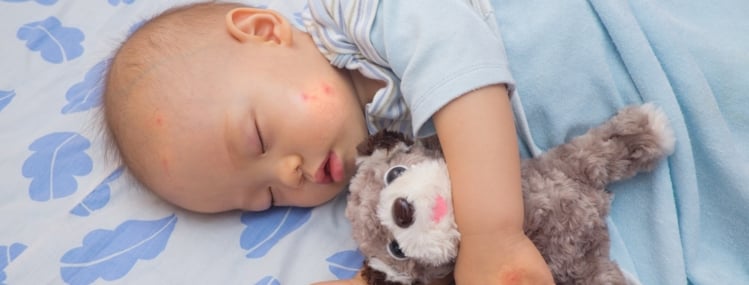 Bug Bites in Babies: Symptoms You Shouldn’t Ignore Bug Bites in Babies: Symptoms You Shouldn’t Ignore
