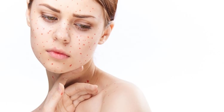 Rubella Virus During Pregnancy — A Complete Guide to German Measles Rubella Virus During Pregnancy — A Complete Guide to German Measles