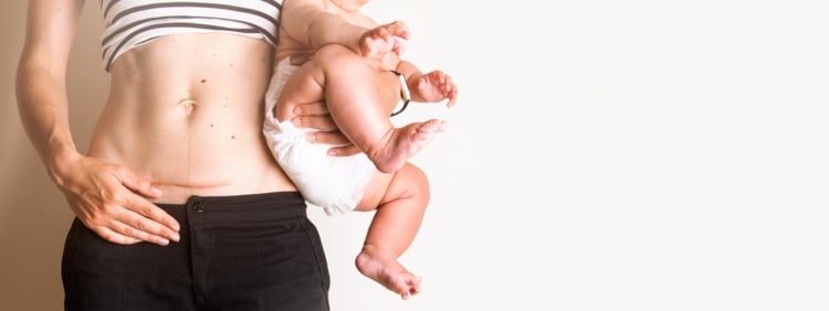 Cómo cuidar tus puntos después del parto para minimizar el riesgo de infección
