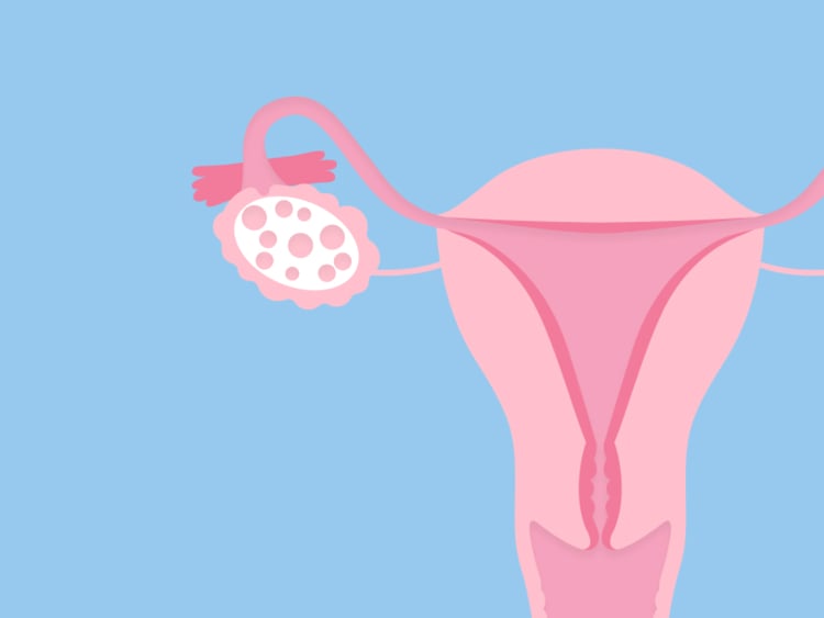 PCOS treatment: What are your options? PCOS treatment: What are your options?