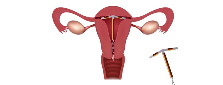 Los dispositivos intrauterinos como método anticonceptivo: usar el DIU por primera vez