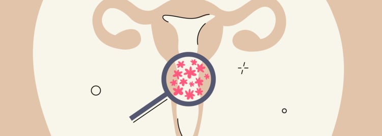 Cervical Dysplasia: Causes, Treatment, and Prevention Cervical Dysplasia: Causes, Treatment, and Prevention