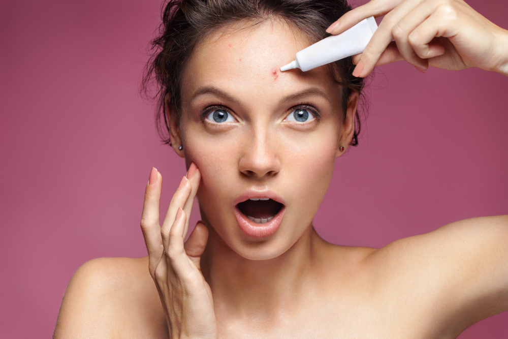 girl with hormonal acne applying treatment cream girl with hormonal acne applying treatment cream