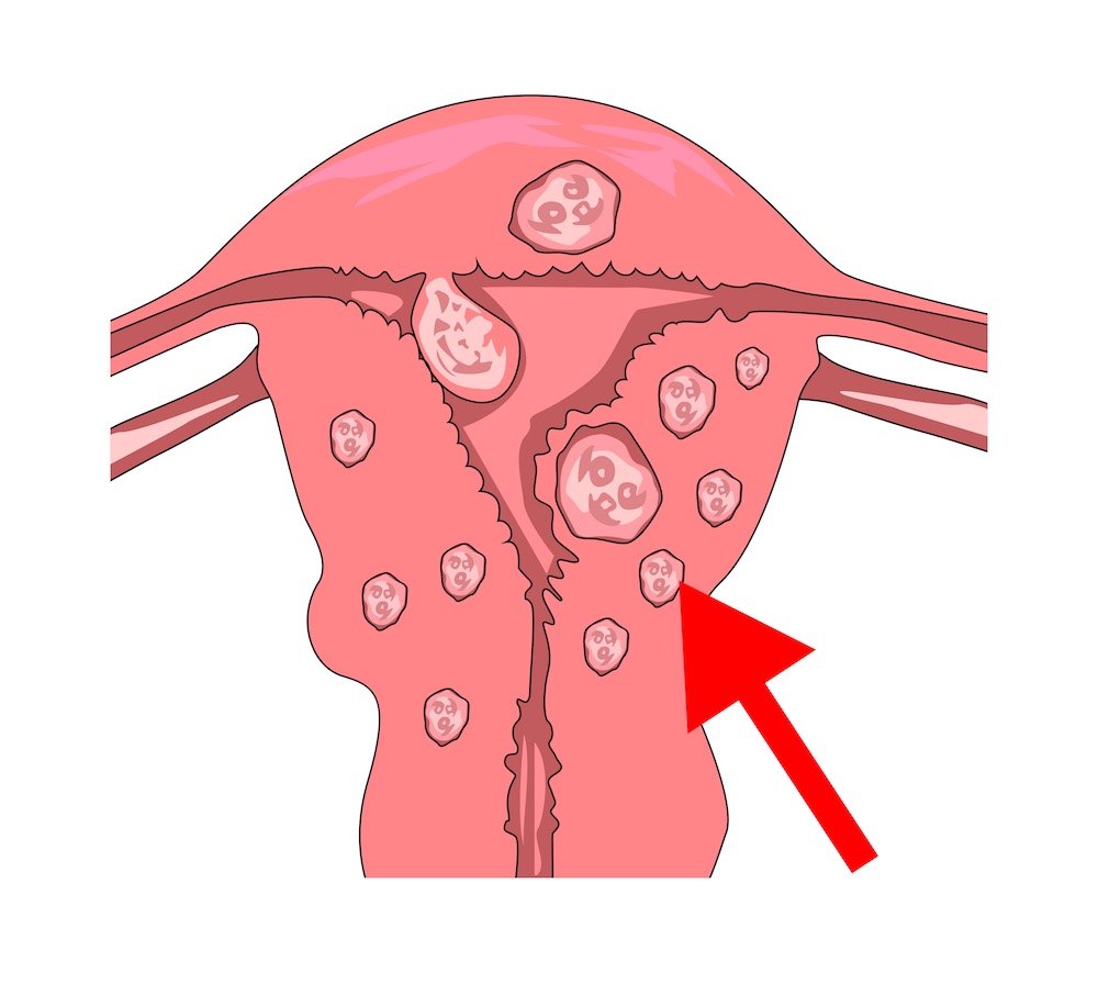 uterine fibroids uterine fibroids