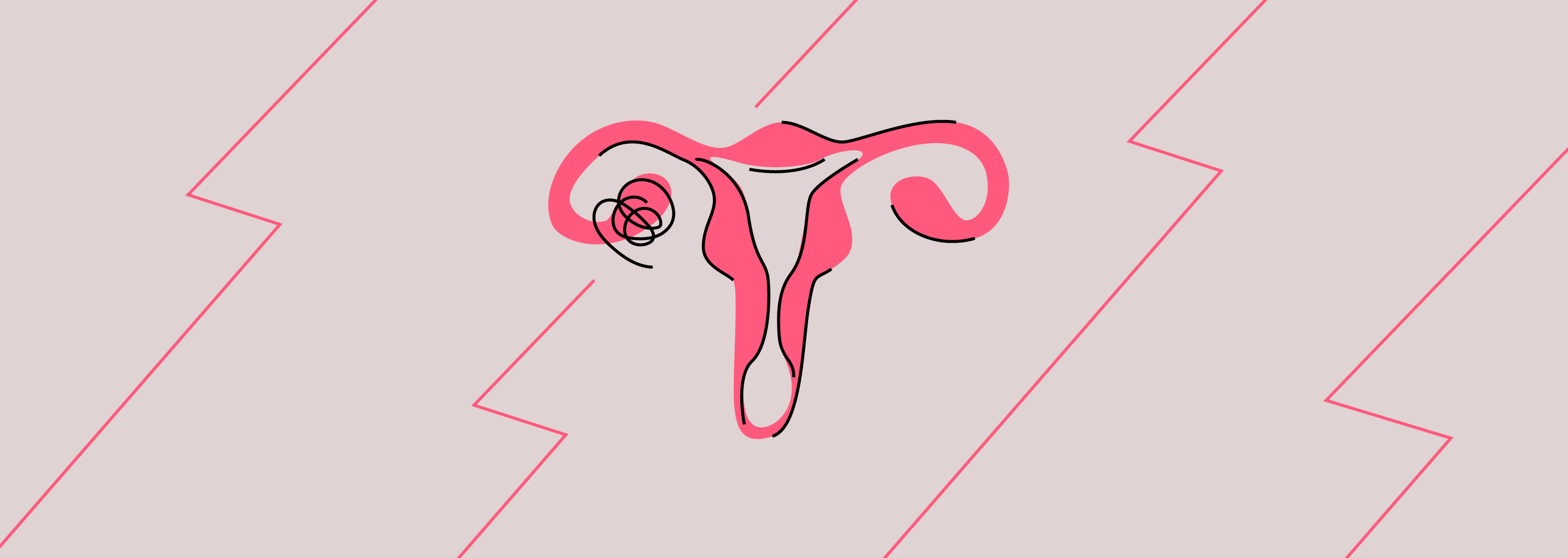 Ovary Pain What Does It Signal